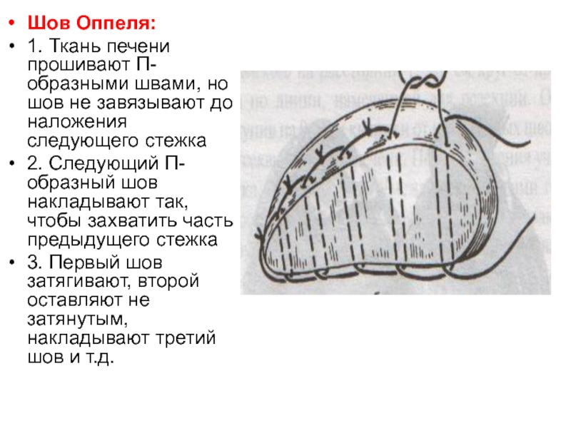 П образный шов в хирургии. П образный шов на ткани.